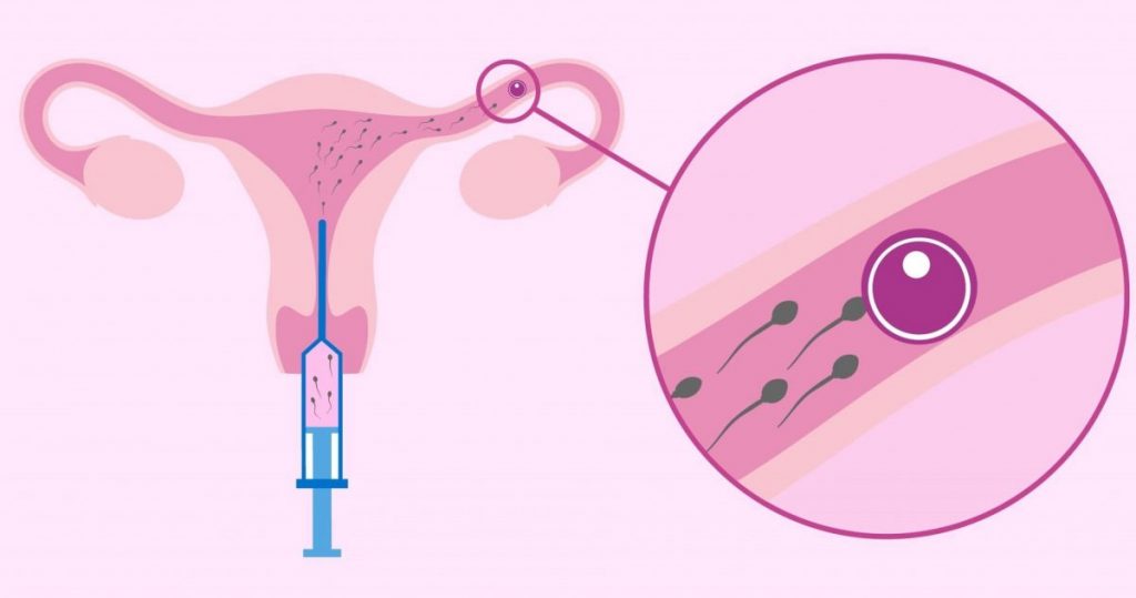 IUI IVF Clinic in Varanasi