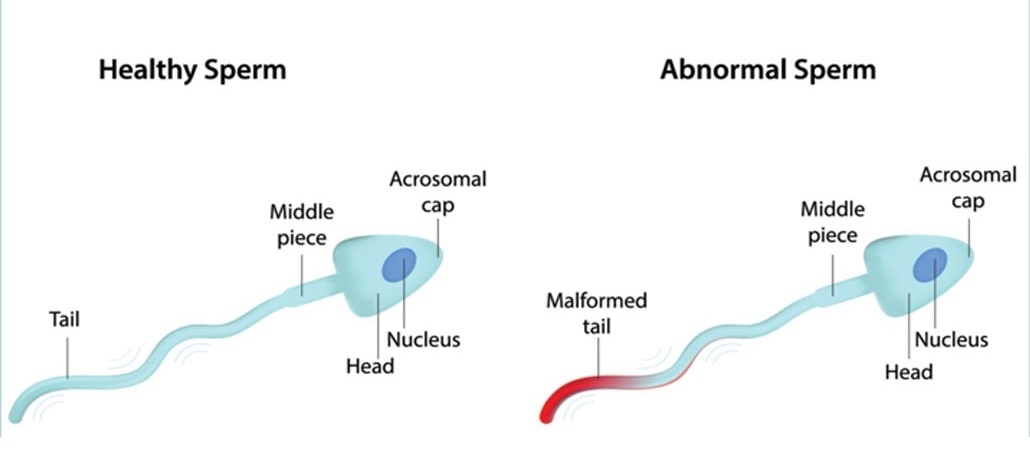male infertility treatment 